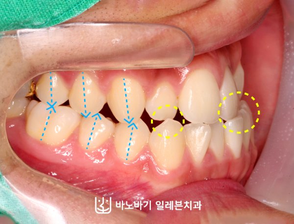 주걱턱 앞니 맞물림 진찰 구내 사진