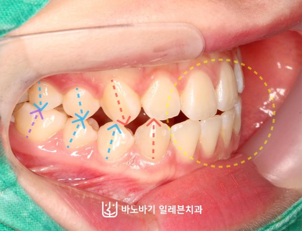 아래턱 위치 유도 진찰 구내 사진