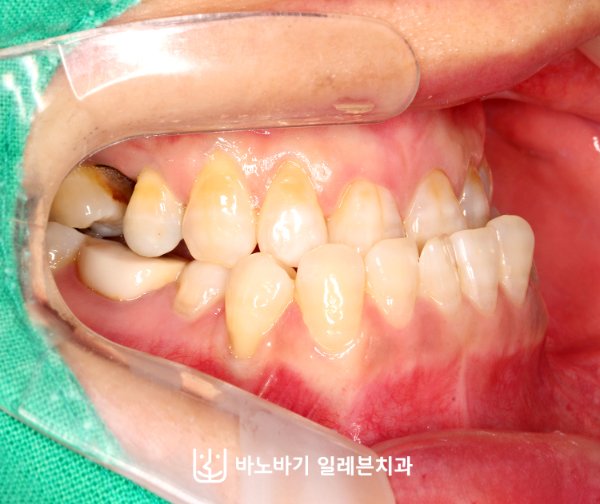 아래 앞니 경사를 보여 주는 주걱턱 구내 측면 사진