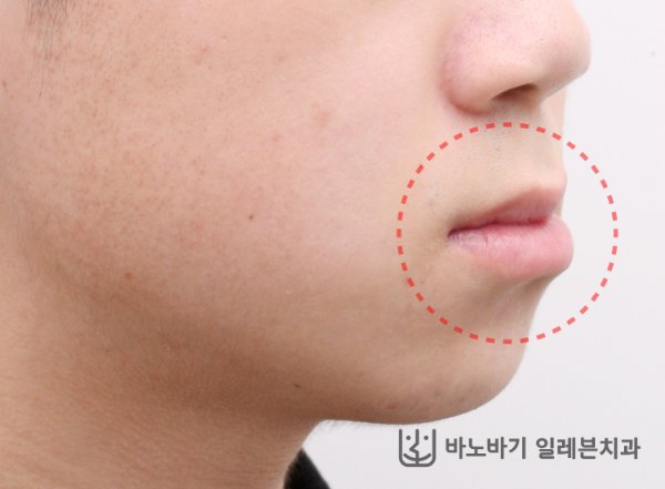 주걱턱 옆모습 진찰 사진