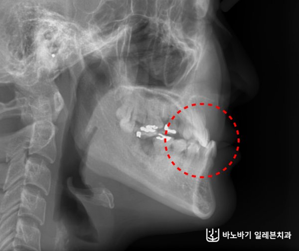 아래 앞니 경사를 확인하는 측면 두부 엑스레이 사진