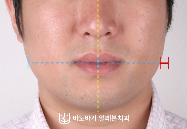 정면 얼굴 중심선과 턱끝 방향 진찰 사진