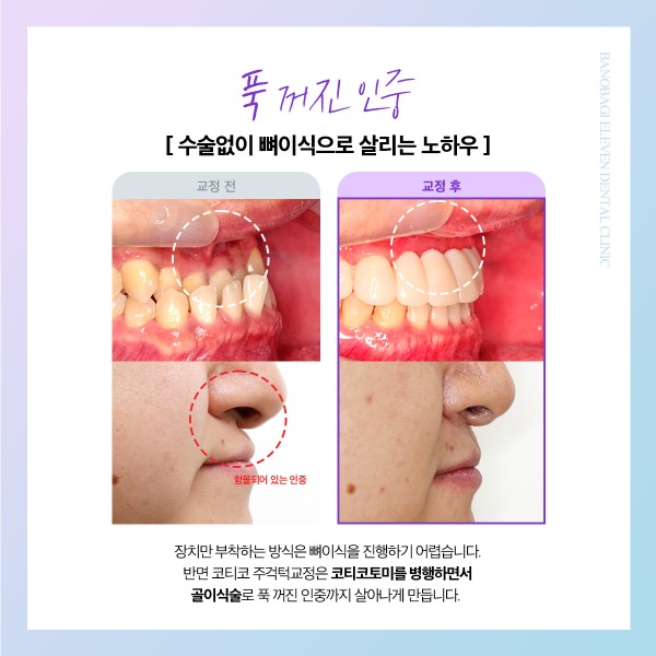 비발치 교정 전후 입매와 인중 변화 안내 이미지