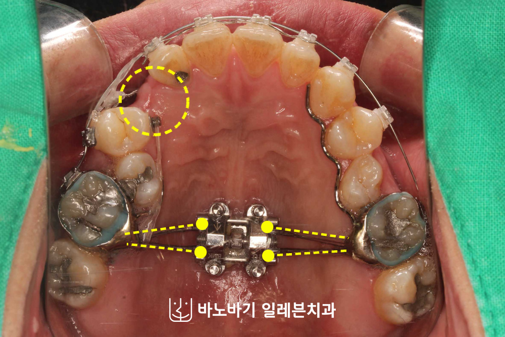 입천장에 부착한 악궁확장장치와 송곳니가 들어설 공간