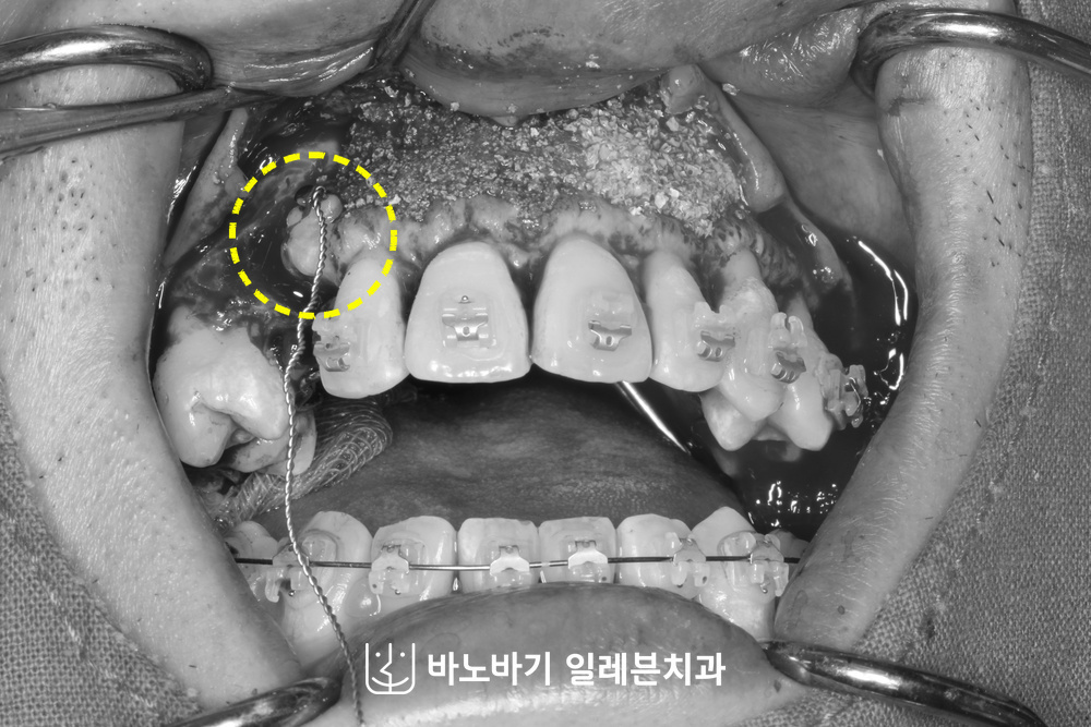 잇몸을 절개하고 치조골을 드러내 노출한 매복 송곳니와 견인용 고리