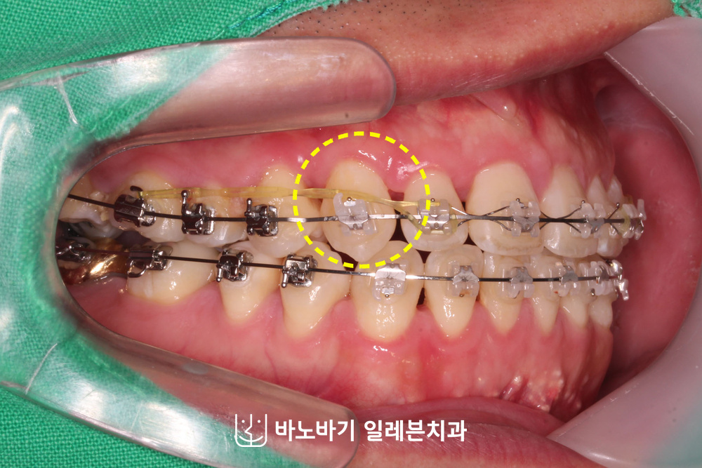 위아래 치아와 맞물리는 위치까지 내려온 송곳니 측면