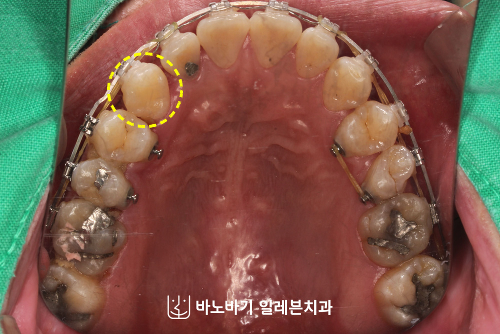 잇몸 밖으로 나와 치열 안으로 들어온 송곳니
