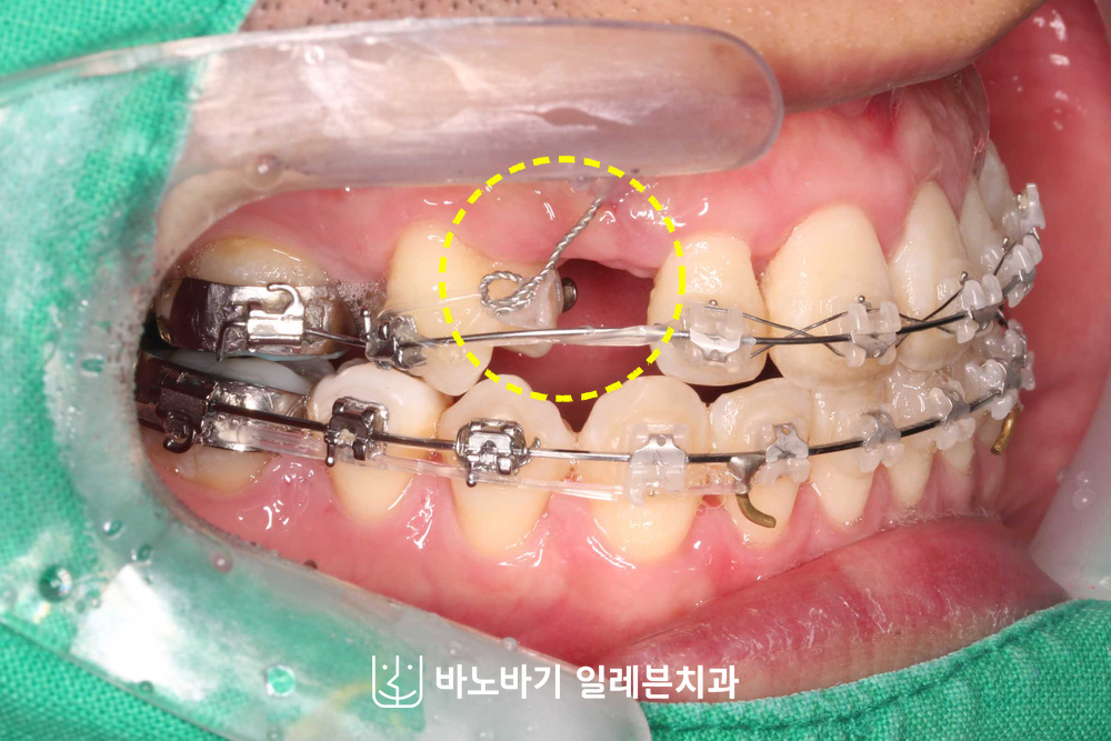 견인용 고리로 매복 송곳니를 아래로 끌어내리는 하방견인 단계