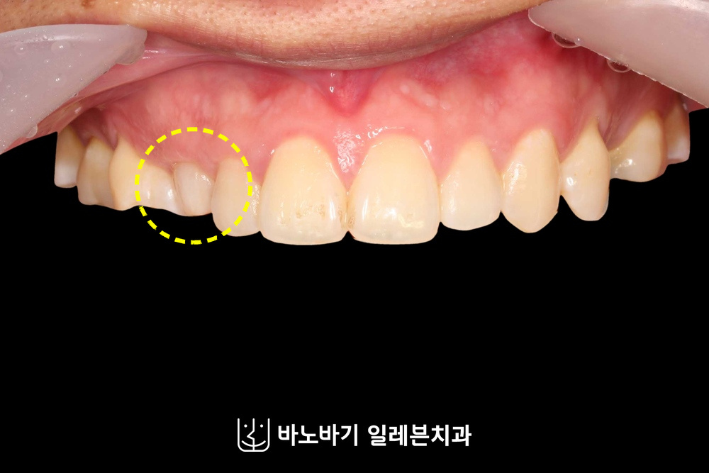 매복치 교정 전 정면, 유치 송곳니가 남아 있는 오른쪽