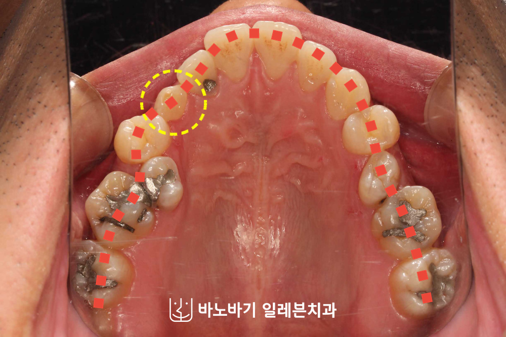 교정 전 상악 교합면