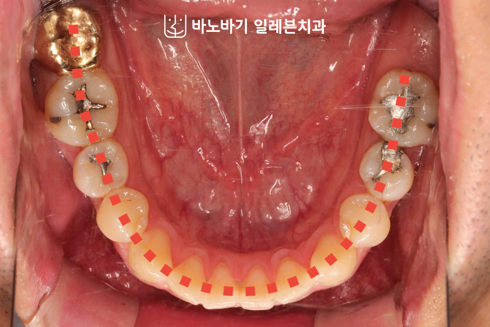 교정 전 하악 교합면