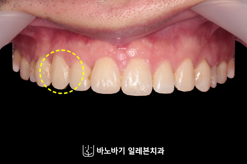 매복치 교정 후 정면, 제자리를 찾은 오른쪽 송곳니
