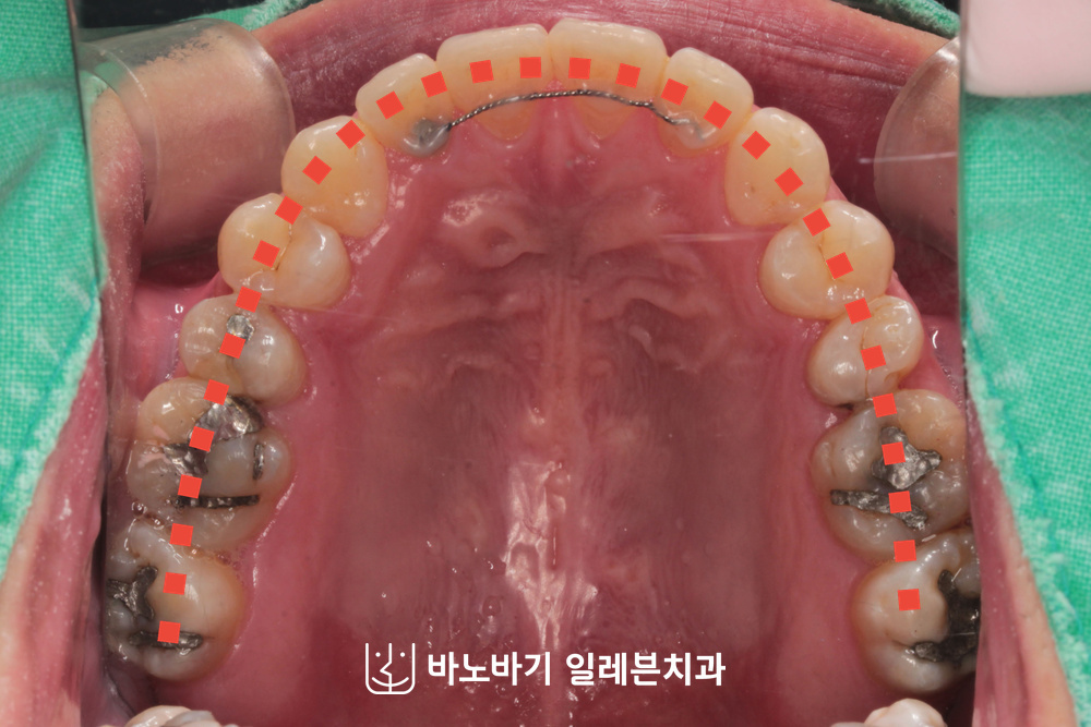 교정 후 상악 교합면