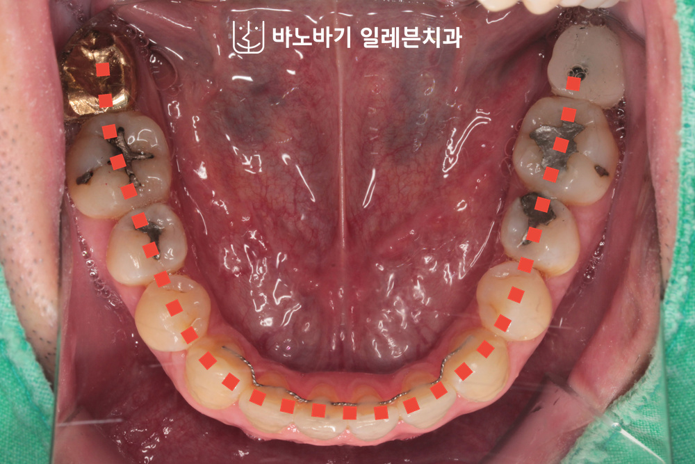 교정 후 하악 교합면