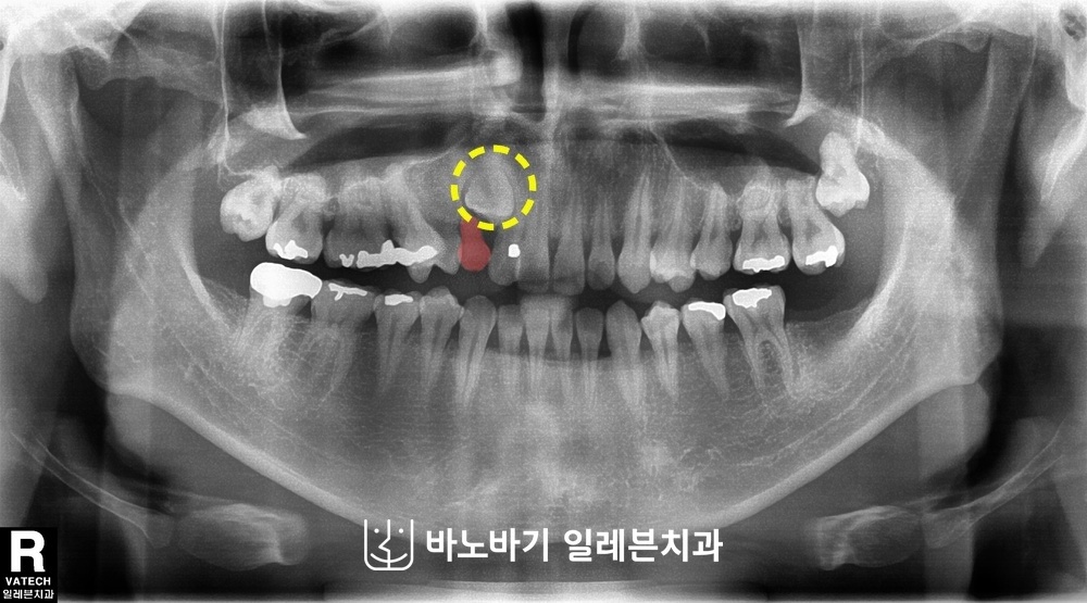 매복치 교정 전 파노라마, 턱뼈 속에 매복된 오른쪽 위 송곳니와 남아 있는 유치 송곳니