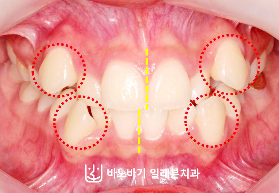 덧니 비발치 교정 전 정면, 전방으로 돌출된 상하악 송곳니 네 곳과 어긋난 중심선