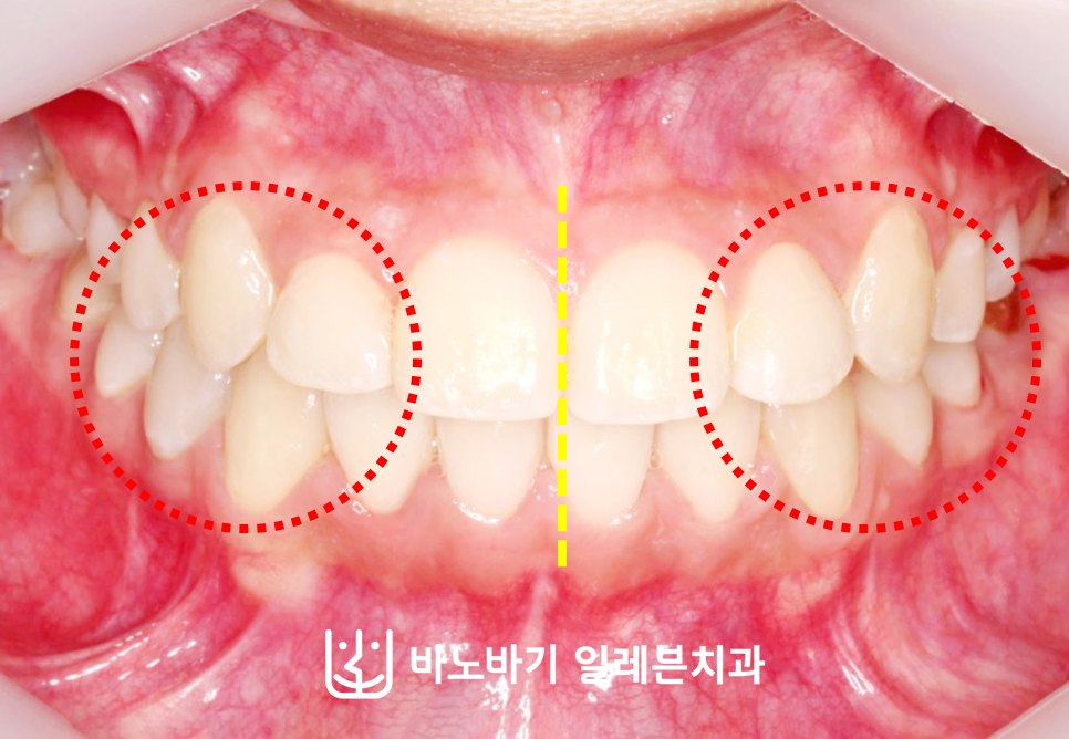 덧니 비발치 교정 후 정면, 본래 위치로 배열된 송곳니와 일치한 중심선