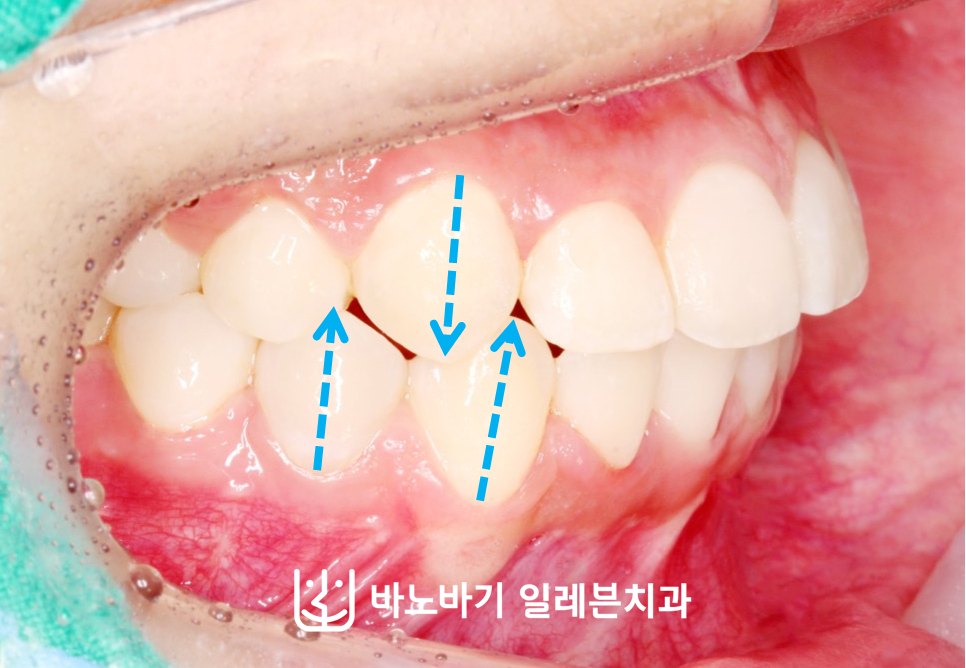 교정 후 우측 측면