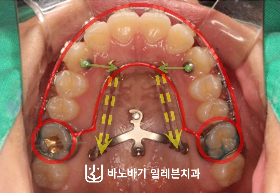상악 구개에 식립한 플레이트로 어금니를 후방으로 이동시키는 모습