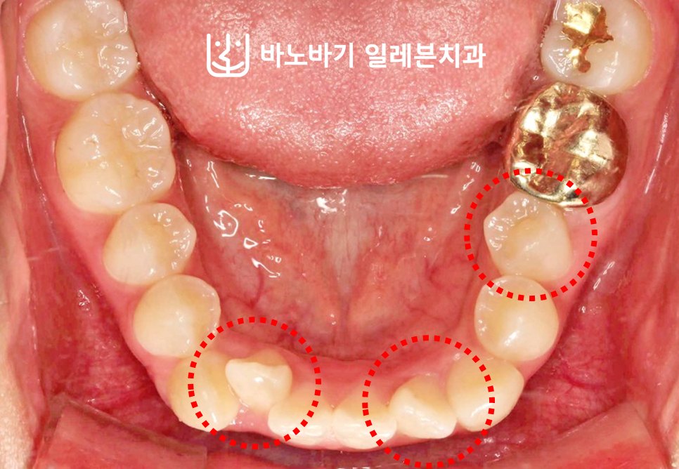 교정 전 하악 교합면, 겹쳐 있는 앞니와 설측으로 기울어진 좌측 제2소구치