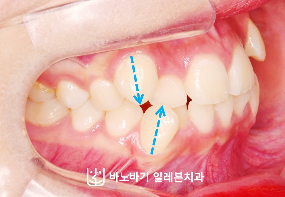 교정 전 우측 측면