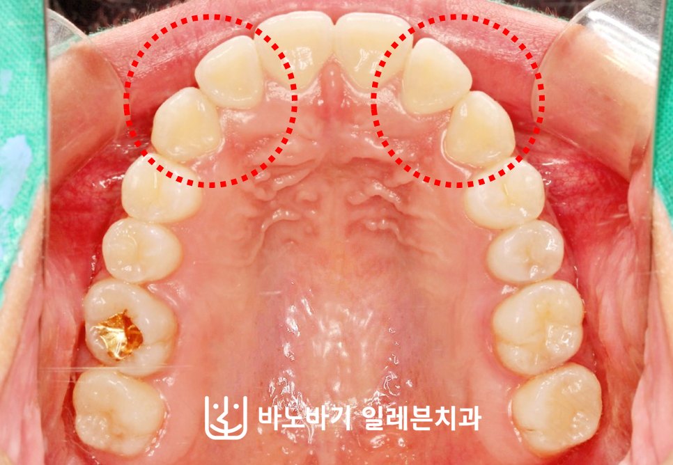교정 후 상악 교합면, U자형 악궁