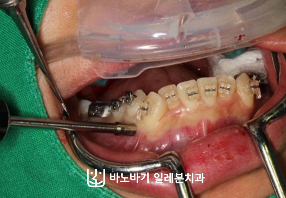치조골의 피질골에 선택적인 자극을 부여하는 코티코토미