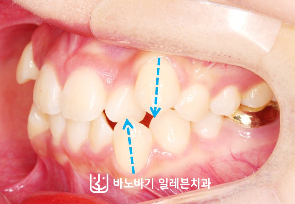 교정 전 좌측 측면