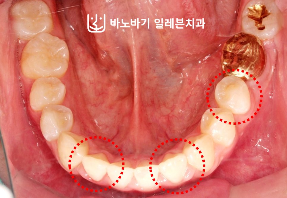 교정 후 하악 교합면, 배열 안으로 들어온 좌측 제2소구치