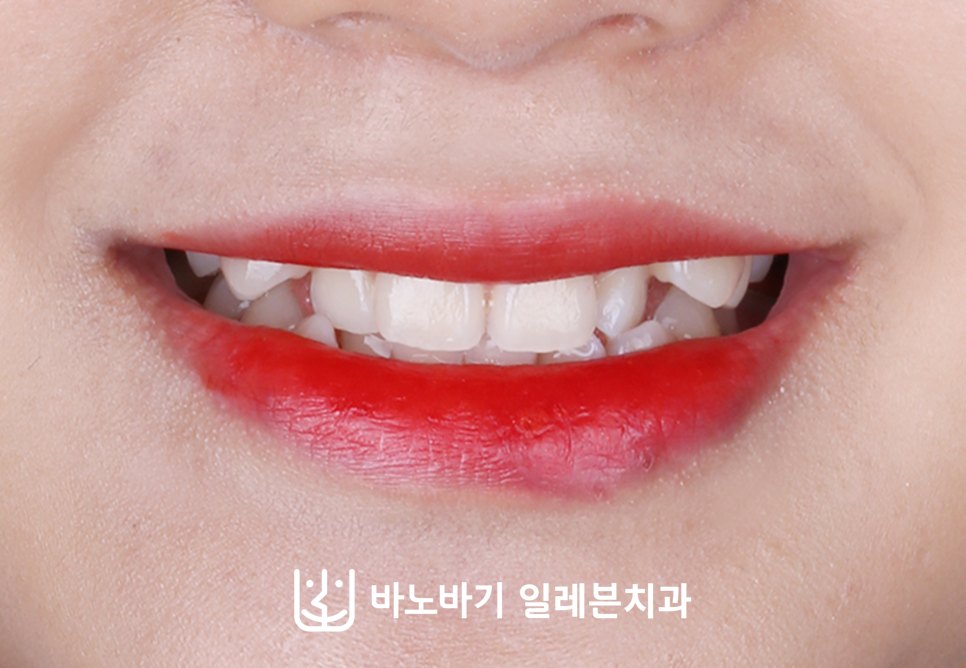교정 전 미소