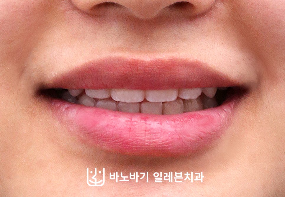교정 후 미소