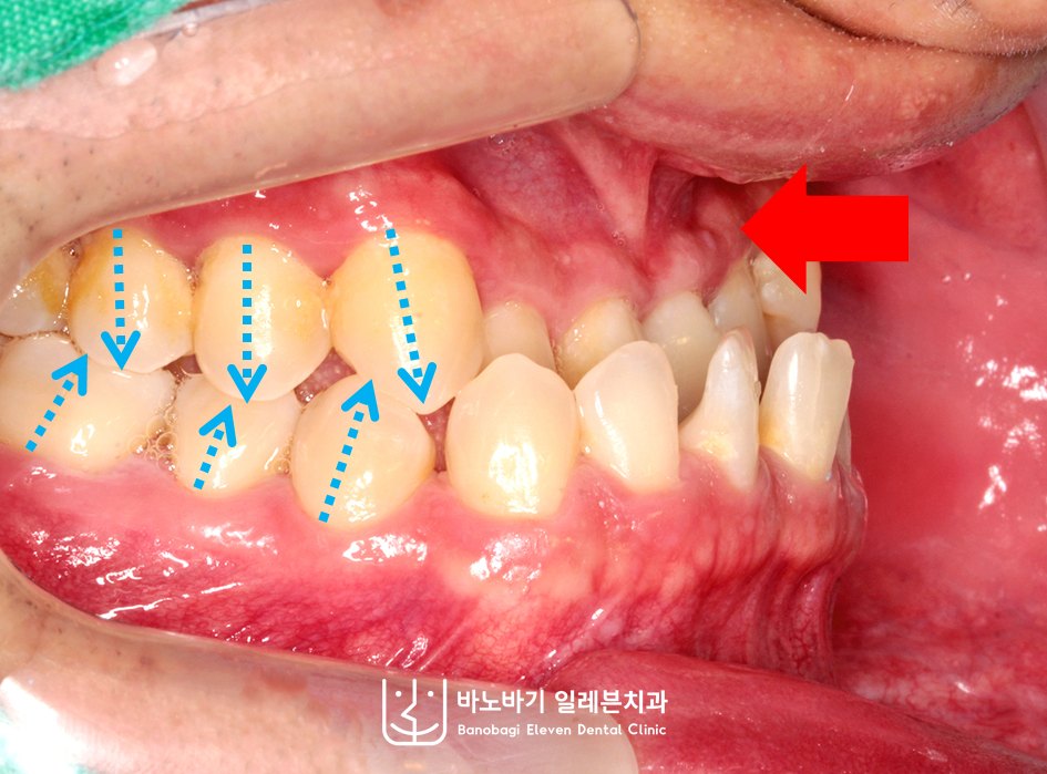 교정 전 우측 측면, 하악 앞니 안쪽에 맞물린 상악 앞니와 눌린 윗잇몸