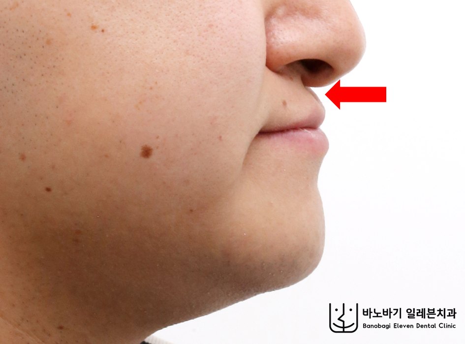 교정 전 측면안모