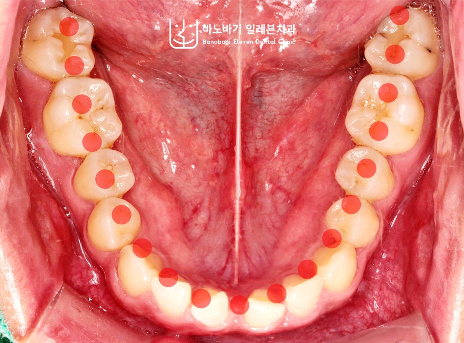 교정 전 하악 교합면