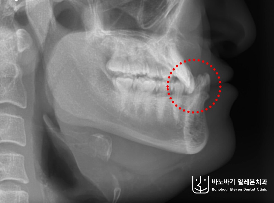 심한 반대교합 교정 전 측면 방사선 사진, 상악보다 크고 앞으로 나온 하악