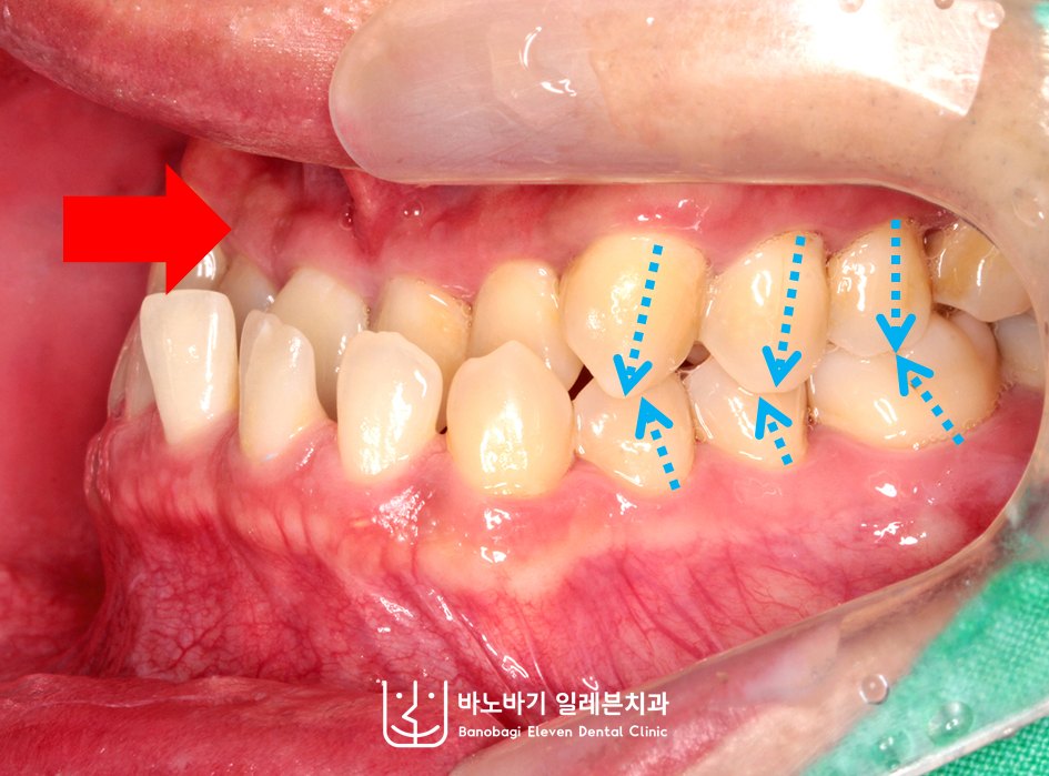 교정 전 좌측 측면