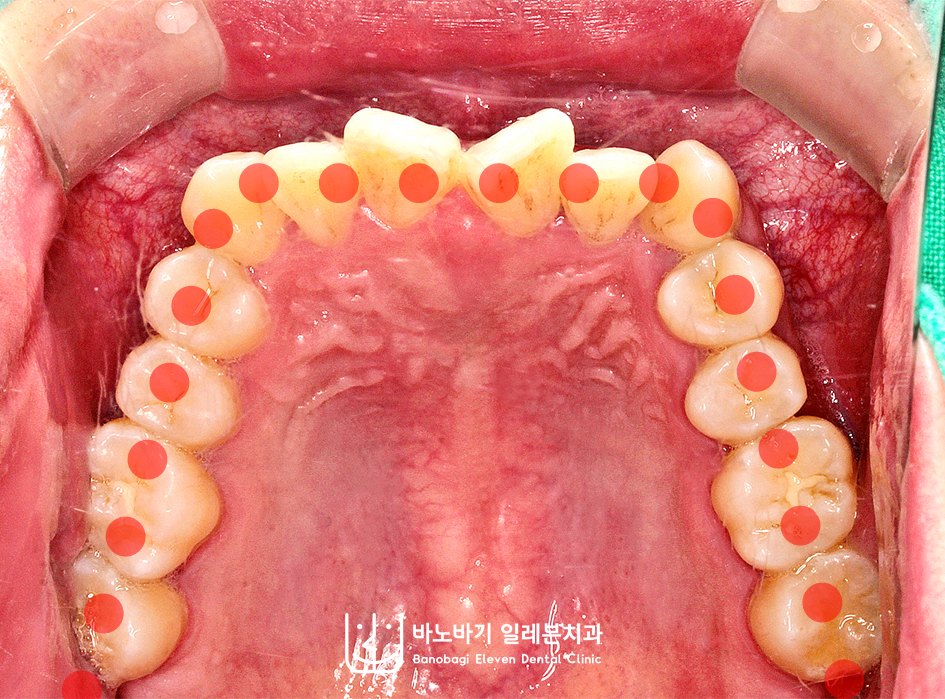 교정 전 상악 교합면, 사다리꼴 형태의 악궁