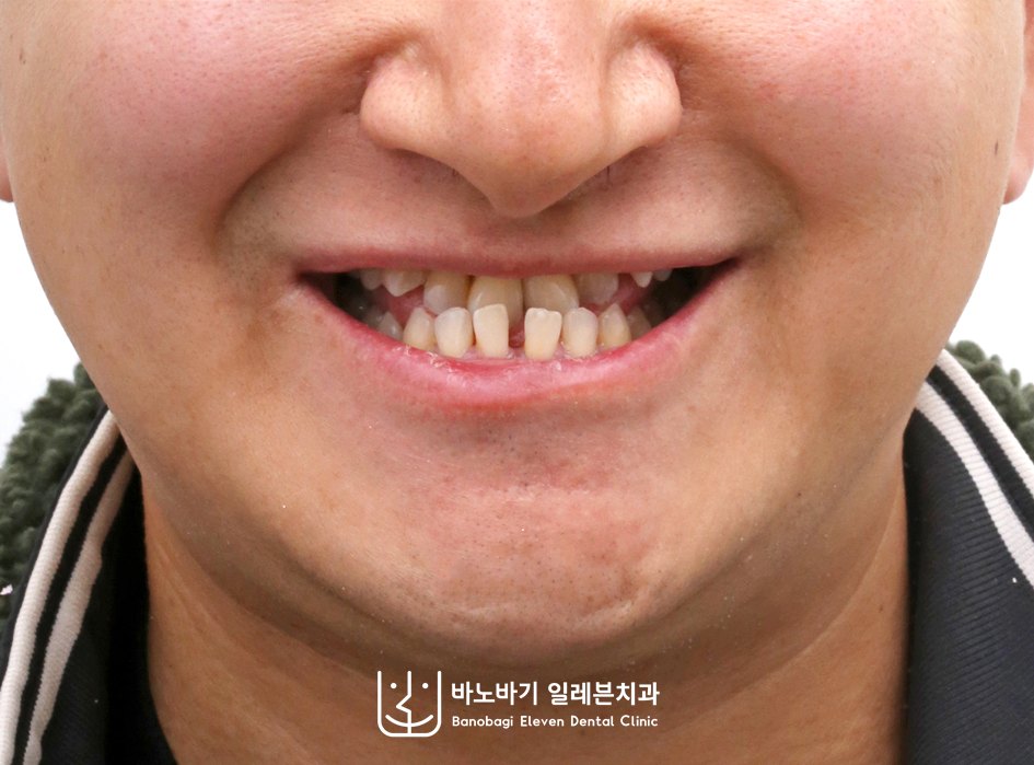 교정 전 정면안모