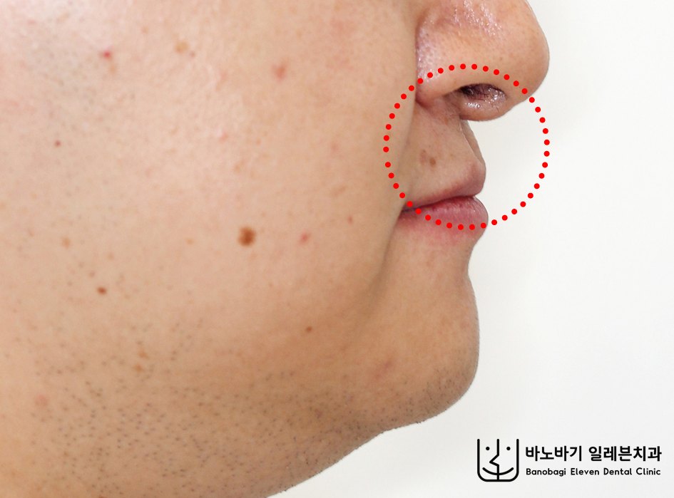교정 후 측면안모