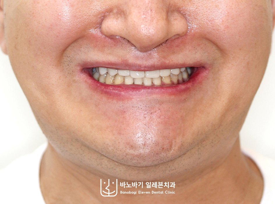 교정 후 정면안모