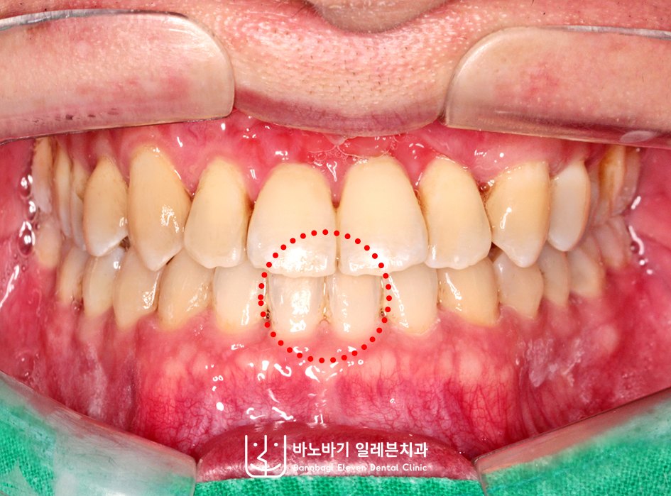 반대교합 교정 후 정면, 정상적으로 맞물린 앞니와 일치한 중심선