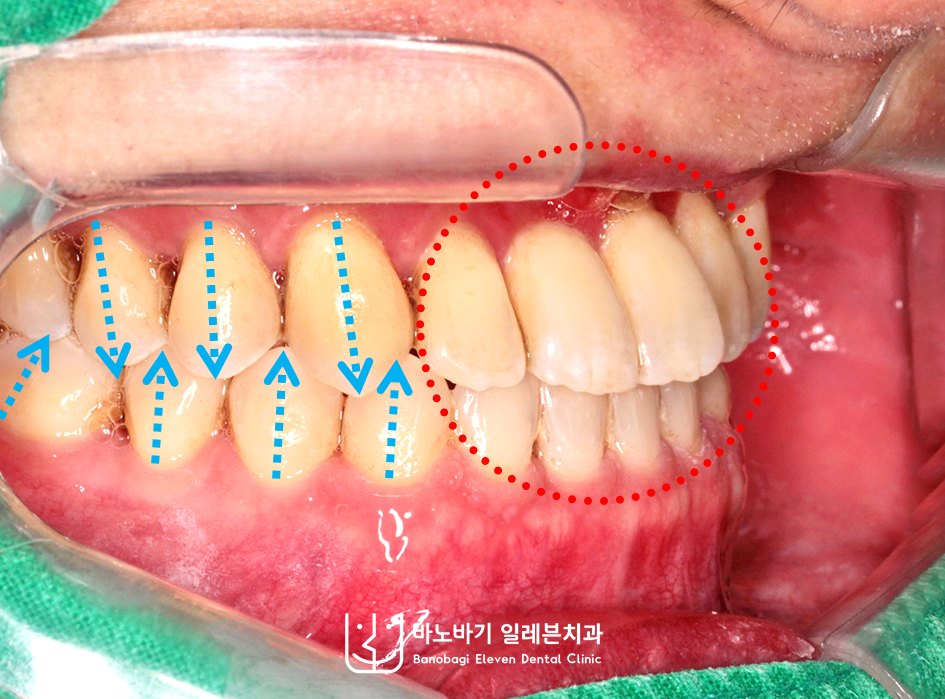 교정 후 우측 측면