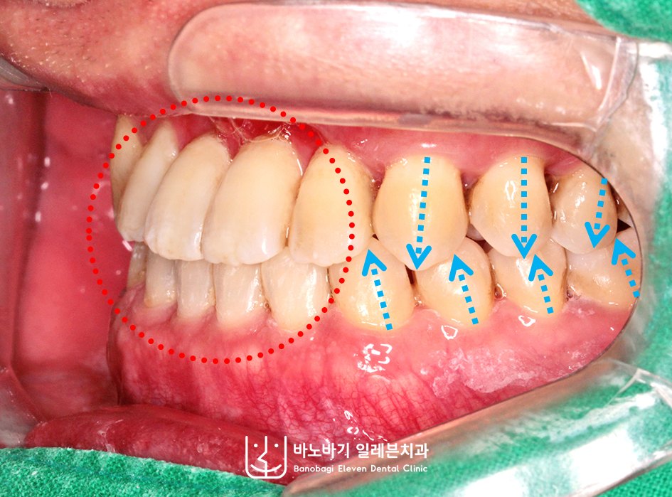 교정 후 좌측 측면