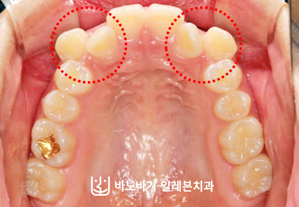 교정 전 상악 교합면, 배열 공간이 부족한 전치부