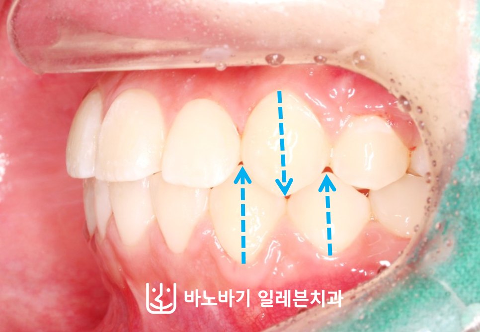 교정 후 좌측 측면
