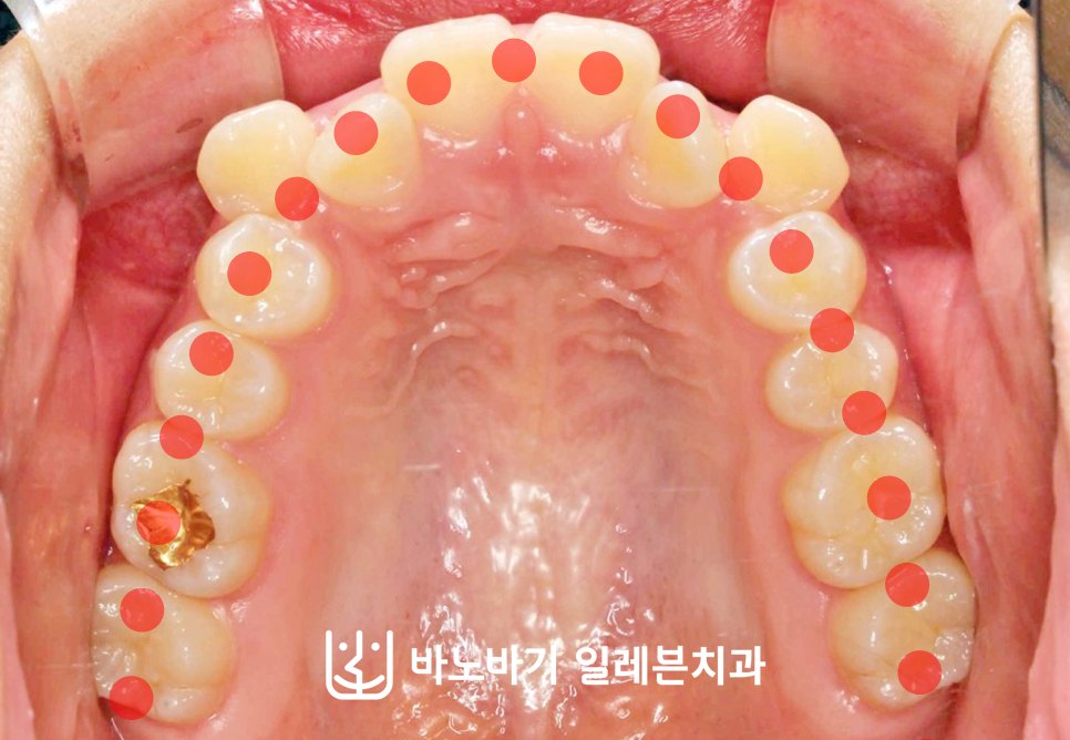 교정 전 상악 교합면, 악궁 라인
