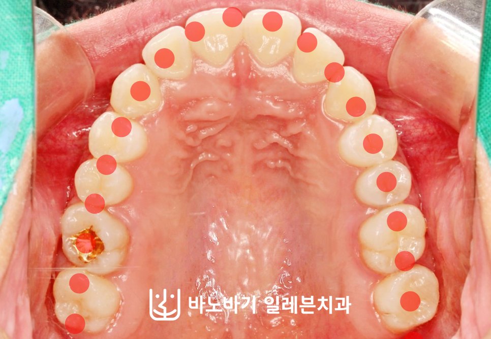 교정 후 상악 교합면, 악궁 라인