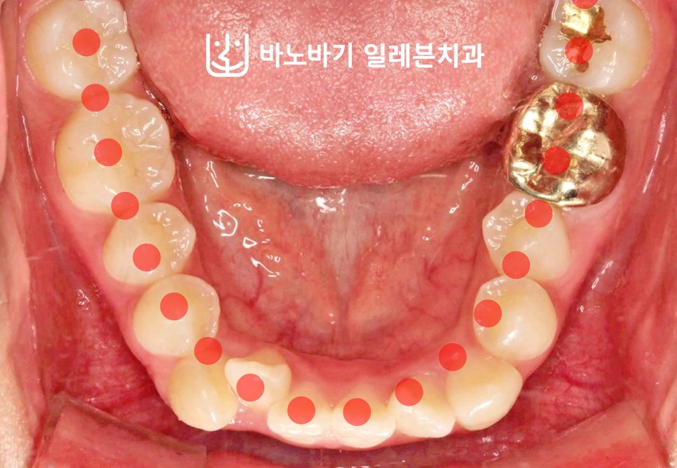 교정 전 하악 교합면, 악궁 라인