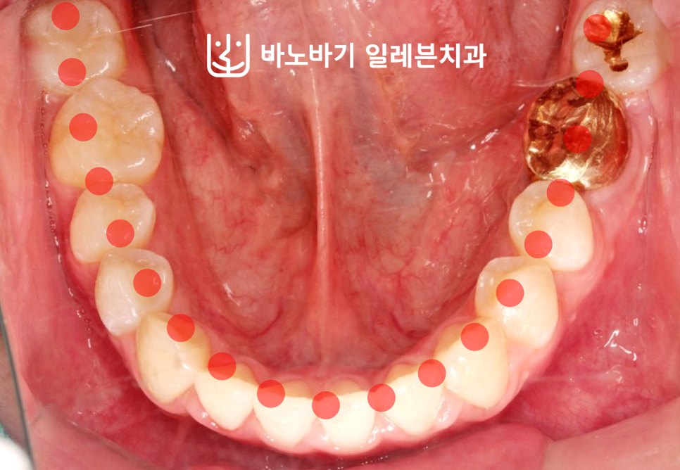 교정 후 하악 교합면, 악궁 라인