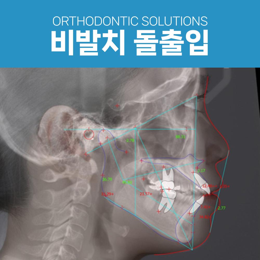 비발치 돌출입